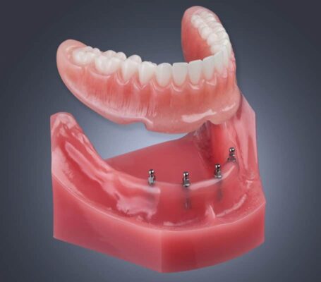 Dentures in Huntsville, AL Implant Denture Chase Family Dentistry