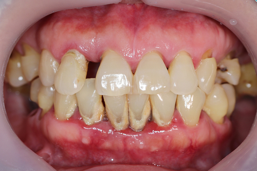Gum Disease Treatment In Huntsville AL Periodontal Disease