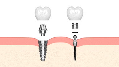 Mini Dental Implants in Huntsville, AL